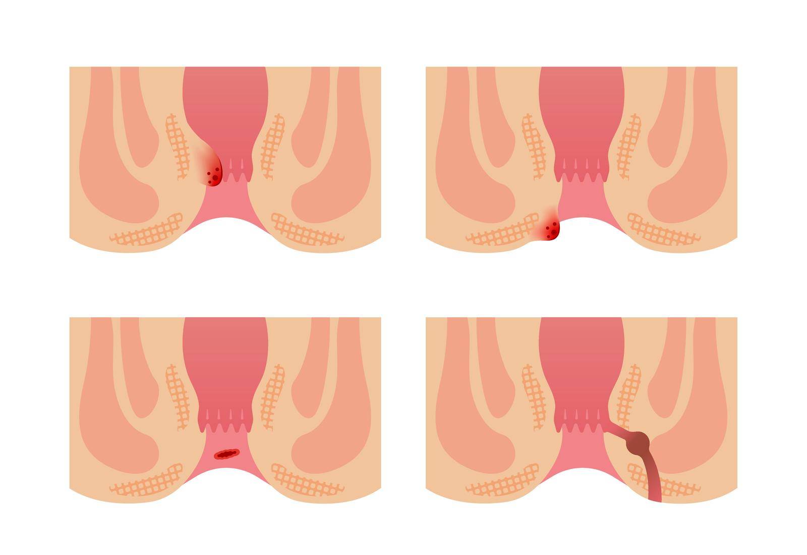 Types of Hemorrhoid flat vector illustration (no text)