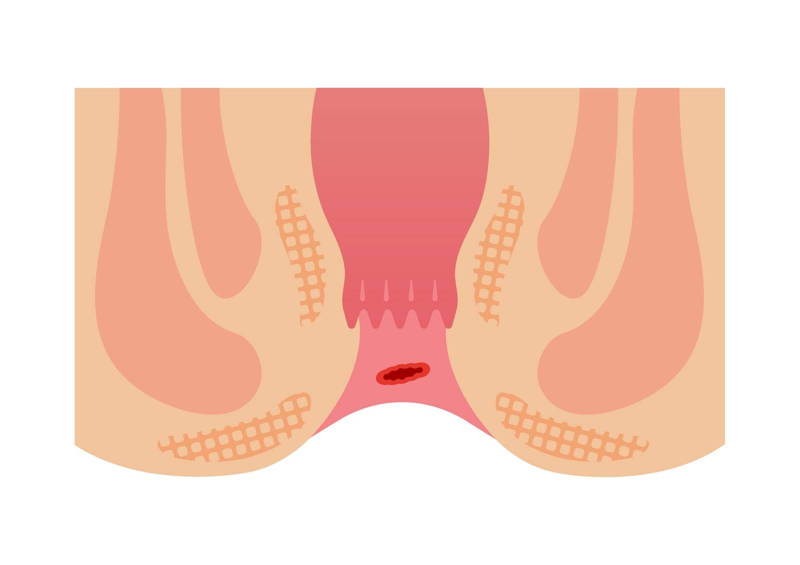 Type of Hemorrhoid flat vector illustration / bleeding hemorrhoids by barks
