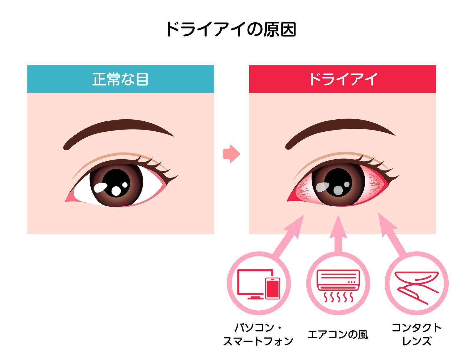 Causes of dry eye vector illustration (Japanese)