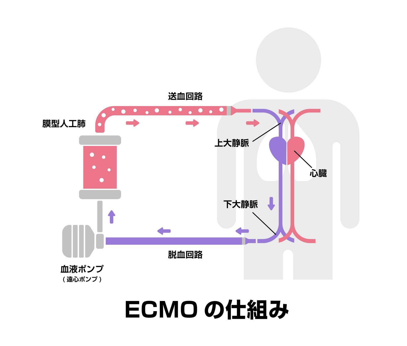 ECMO ( Extracorporeal membrane oxygenation ) structure vector illustration / Japanese by barks