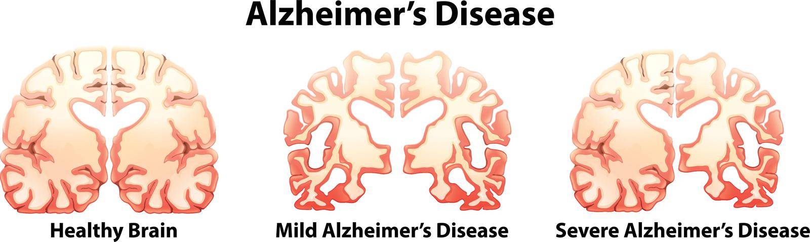 Illustration of the alzheimer's Disease on a white background