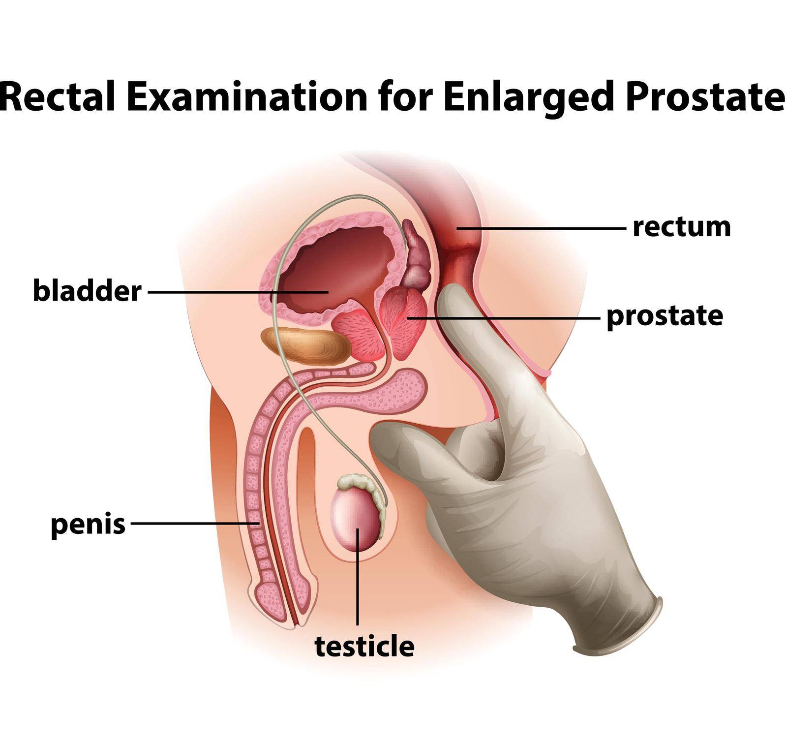 Illustration of a rectal Examination for Enlarged Prostate on a white background