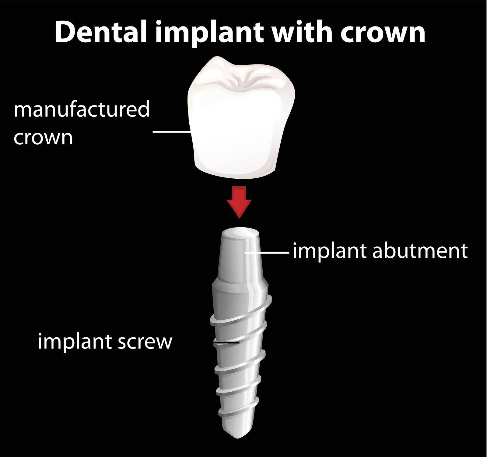 A dental implant with crown by iimages