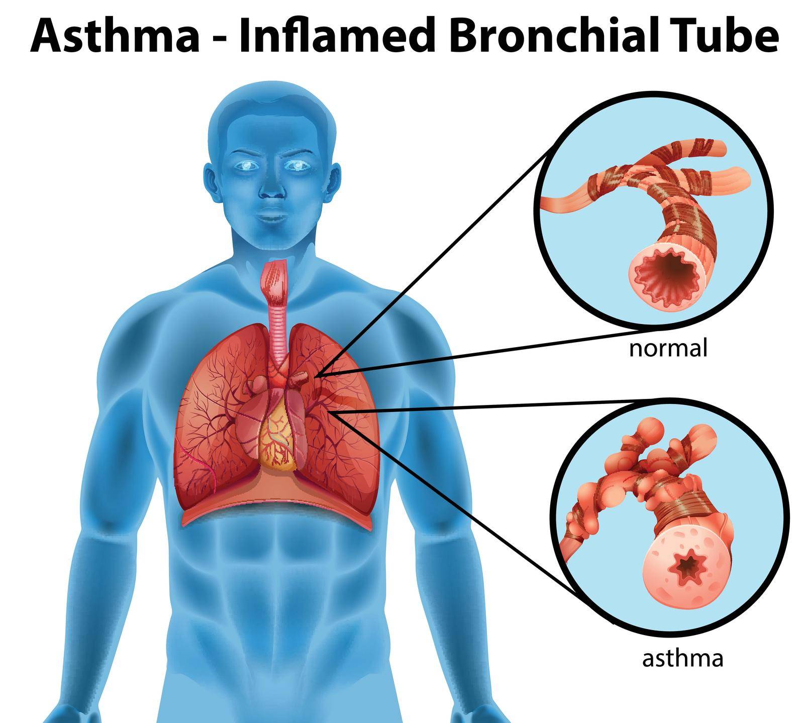 An image showing the asthma-inflamed bronchial tube on a white background