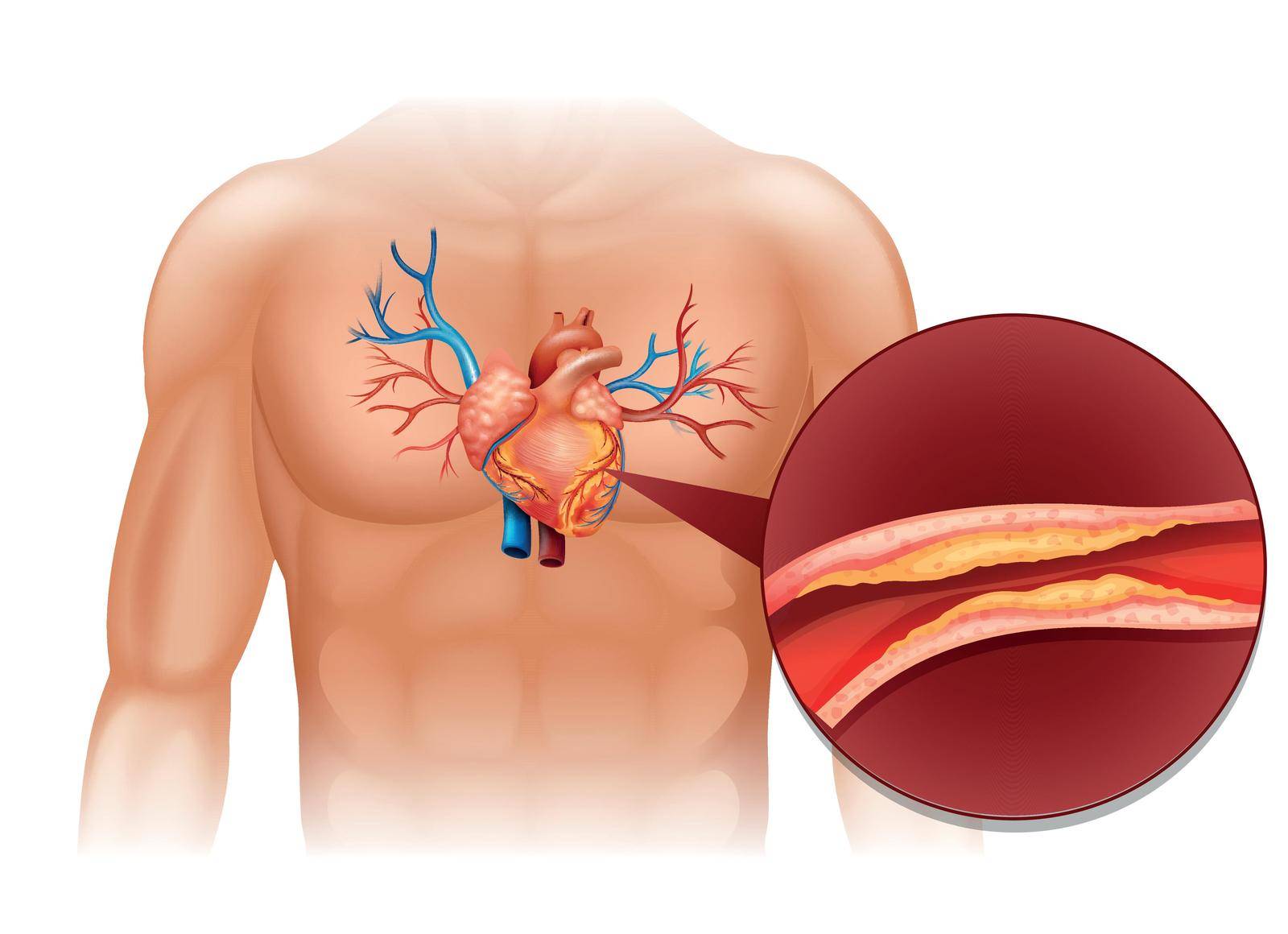 Heart Cholesteral in human body illustration