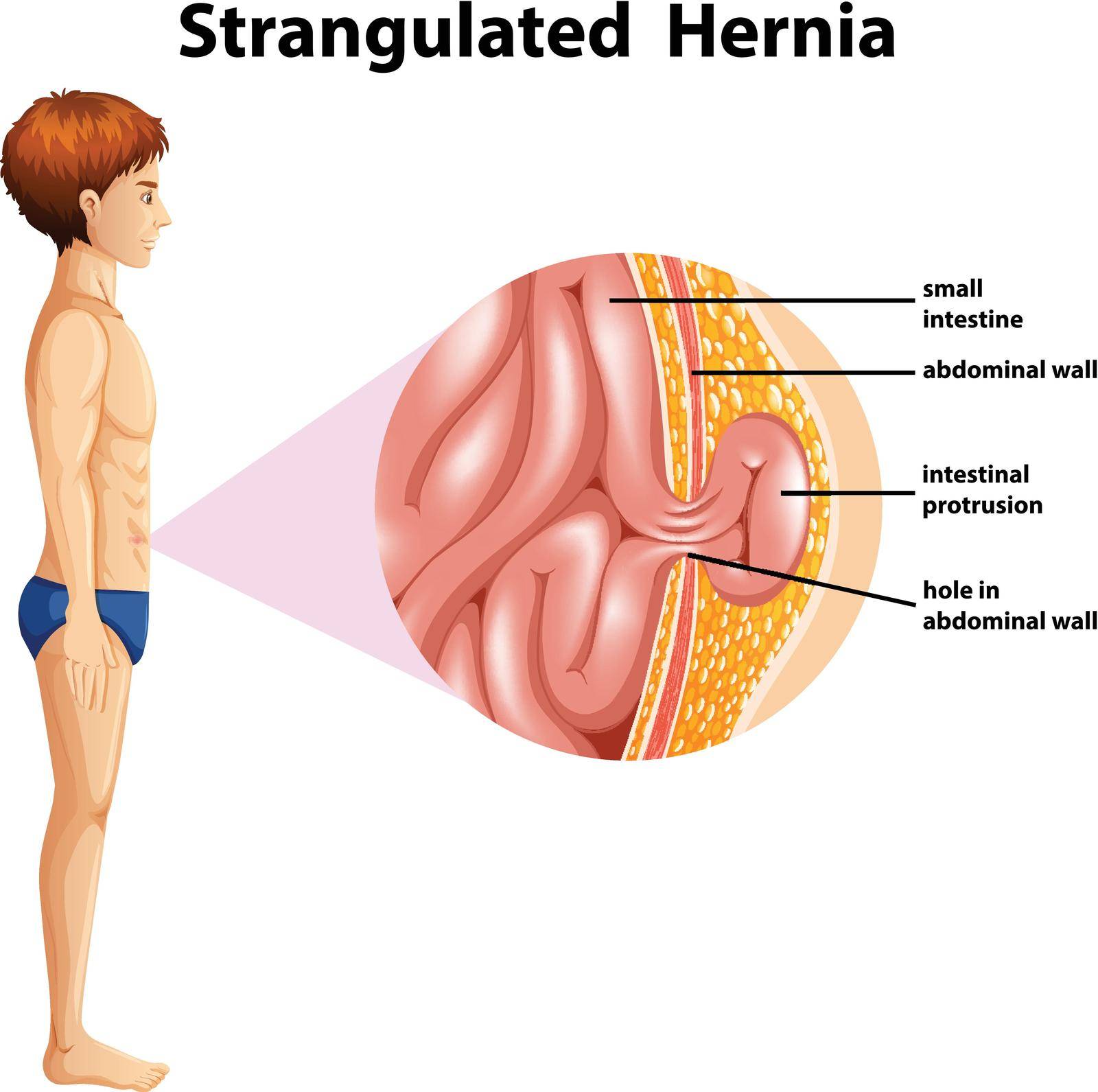 A Human Anatomy Strangulated Hernia illustration