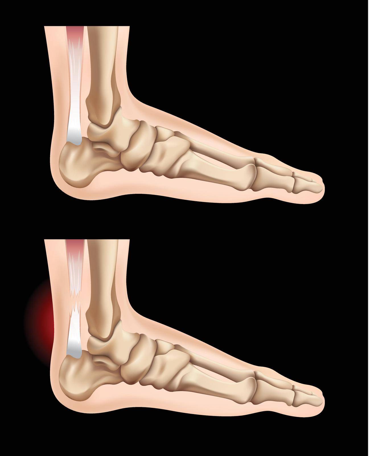 Human feet and injury in tendon by iimages