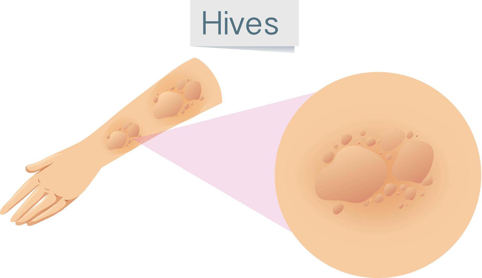 Magnified hives on arm illustration