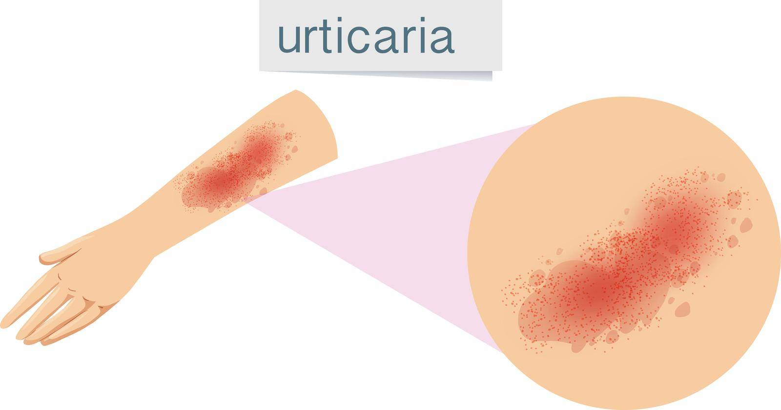 A Human Skin Problem Urticaria by iimages