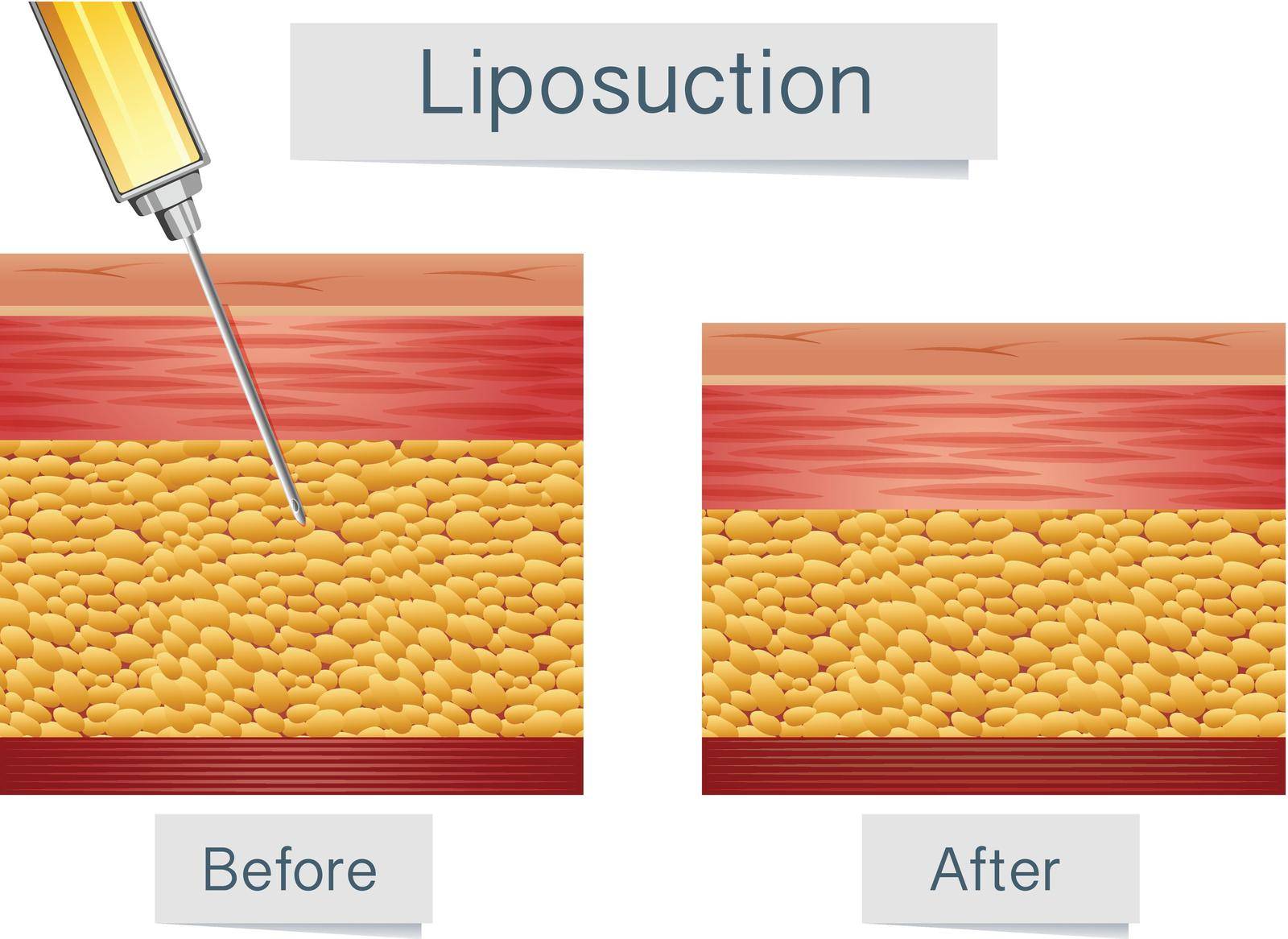 Liposuction Medical Treatment and Comparison illustration