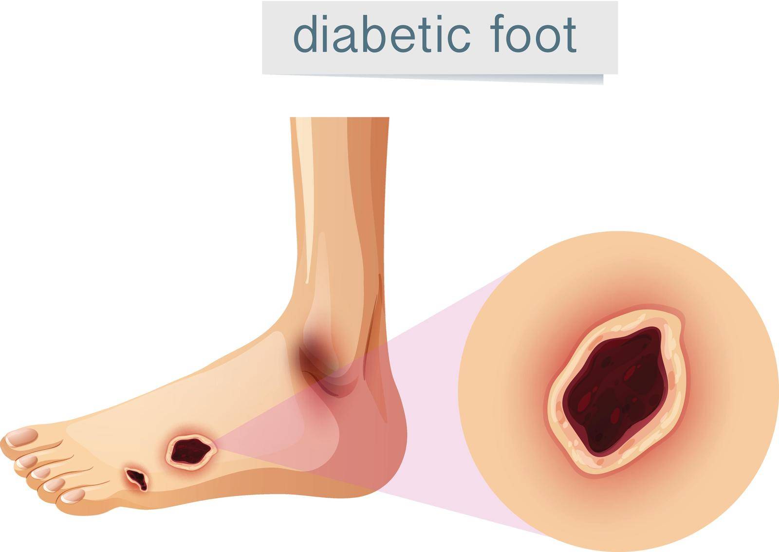 Diabetic foot magnifed on foot illustration