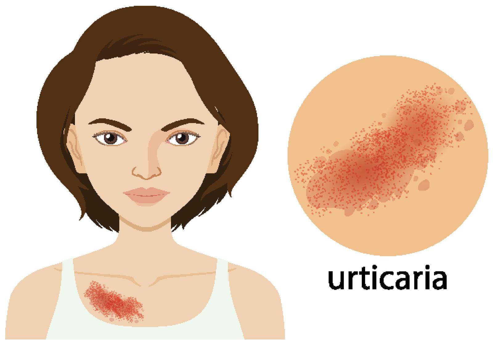Diagram showing urticaria on human female illustration