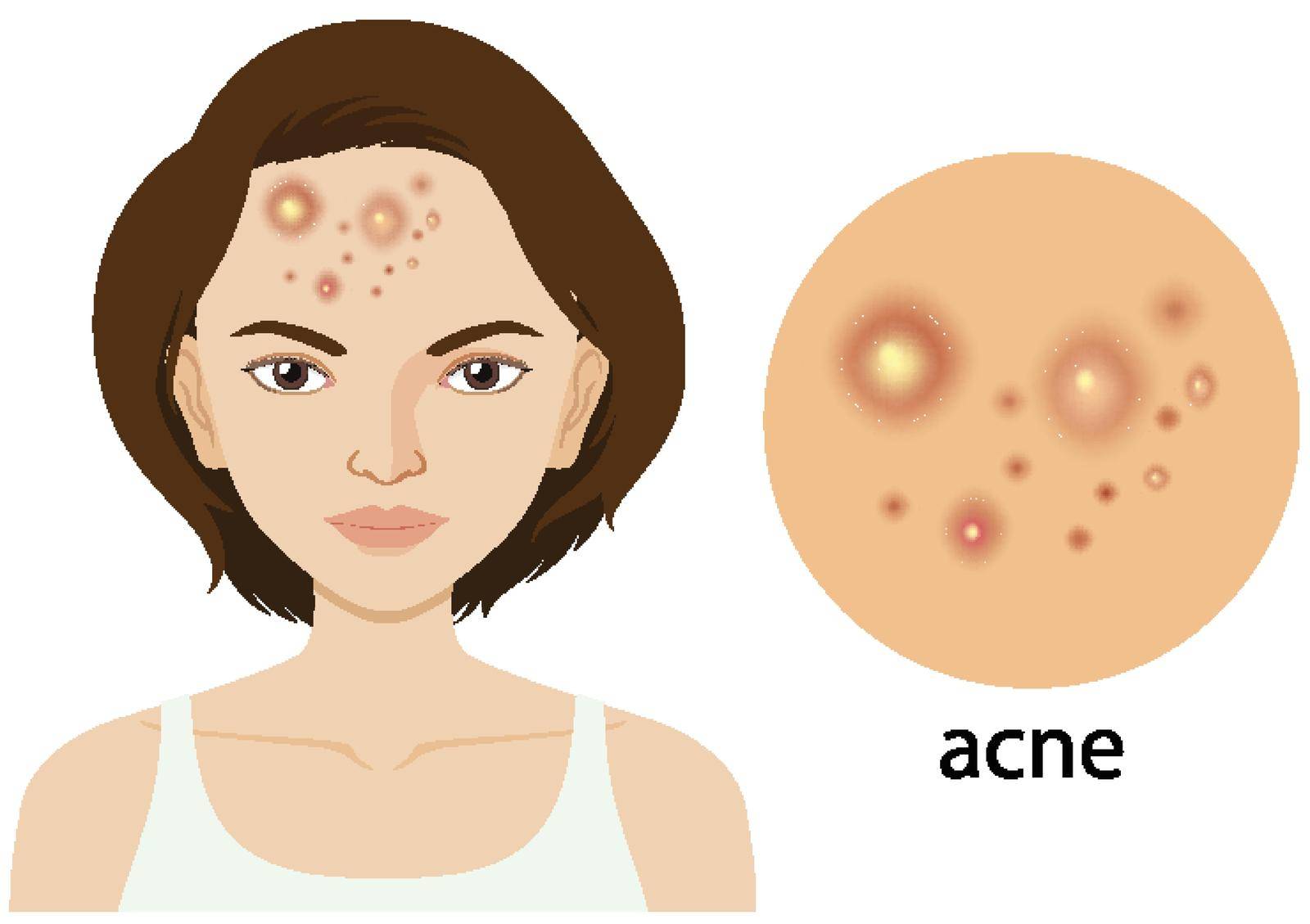 Diagram showing woman with acne problem illustration