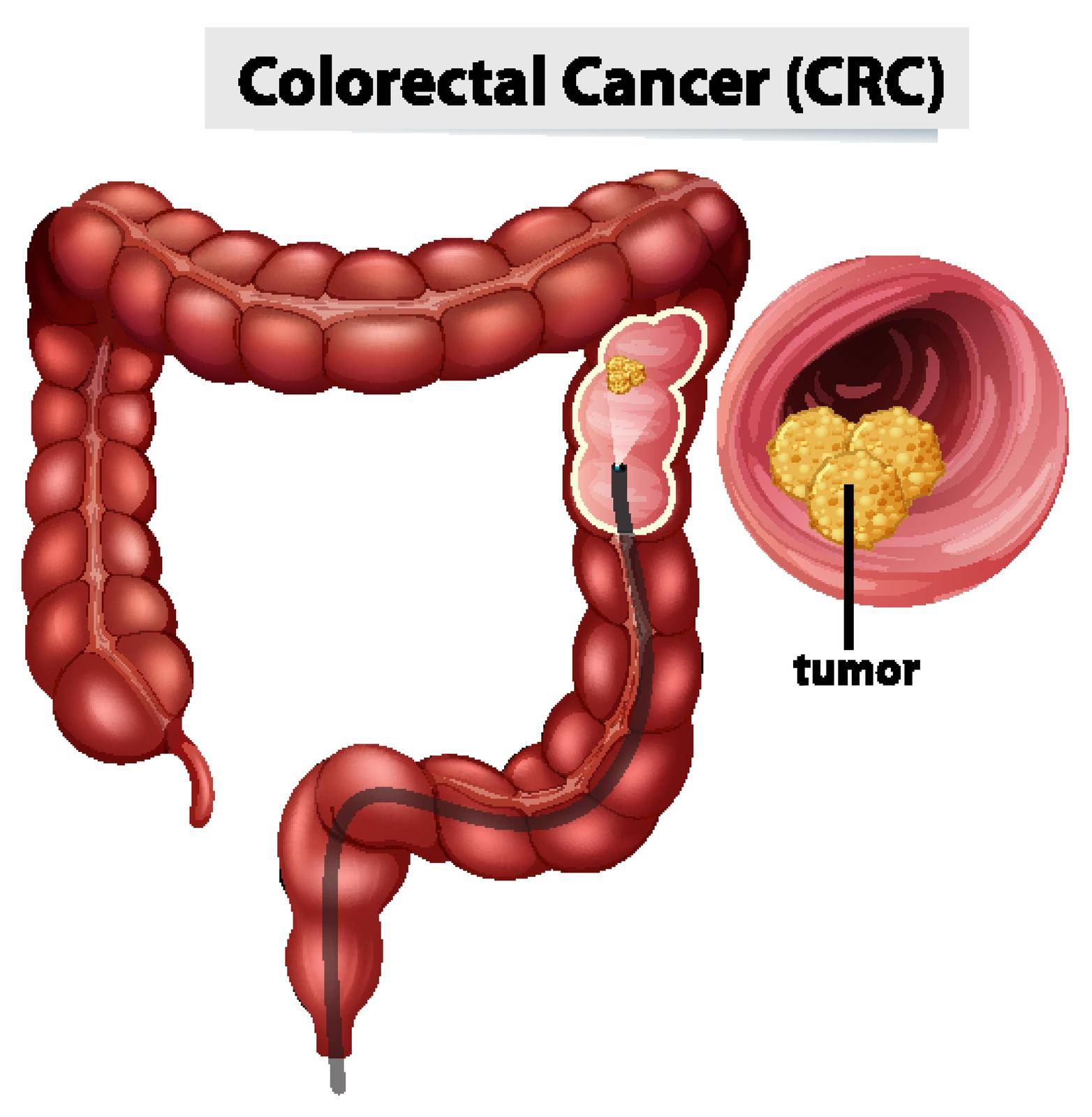 Colorectal Cancer (CRC) infographic for education by iimages