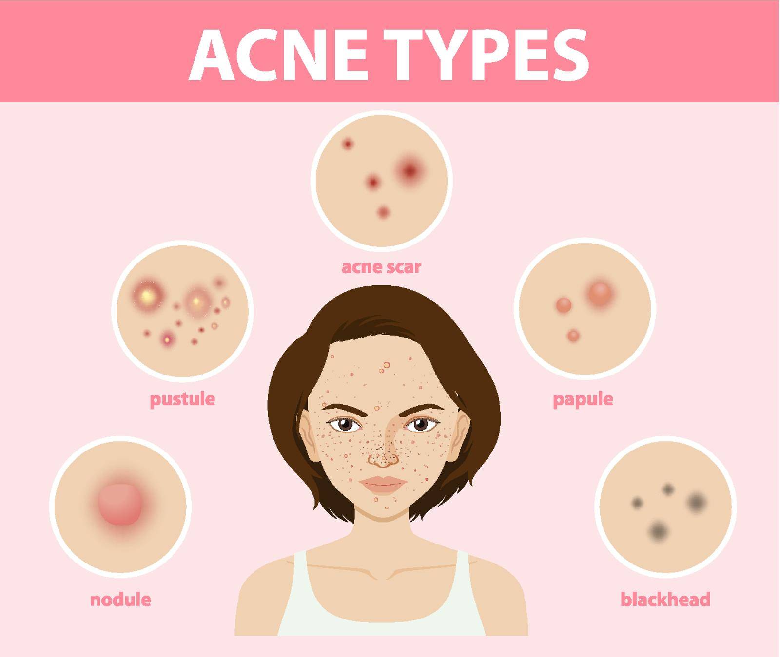 Types of acne on the skin or pimples illustration