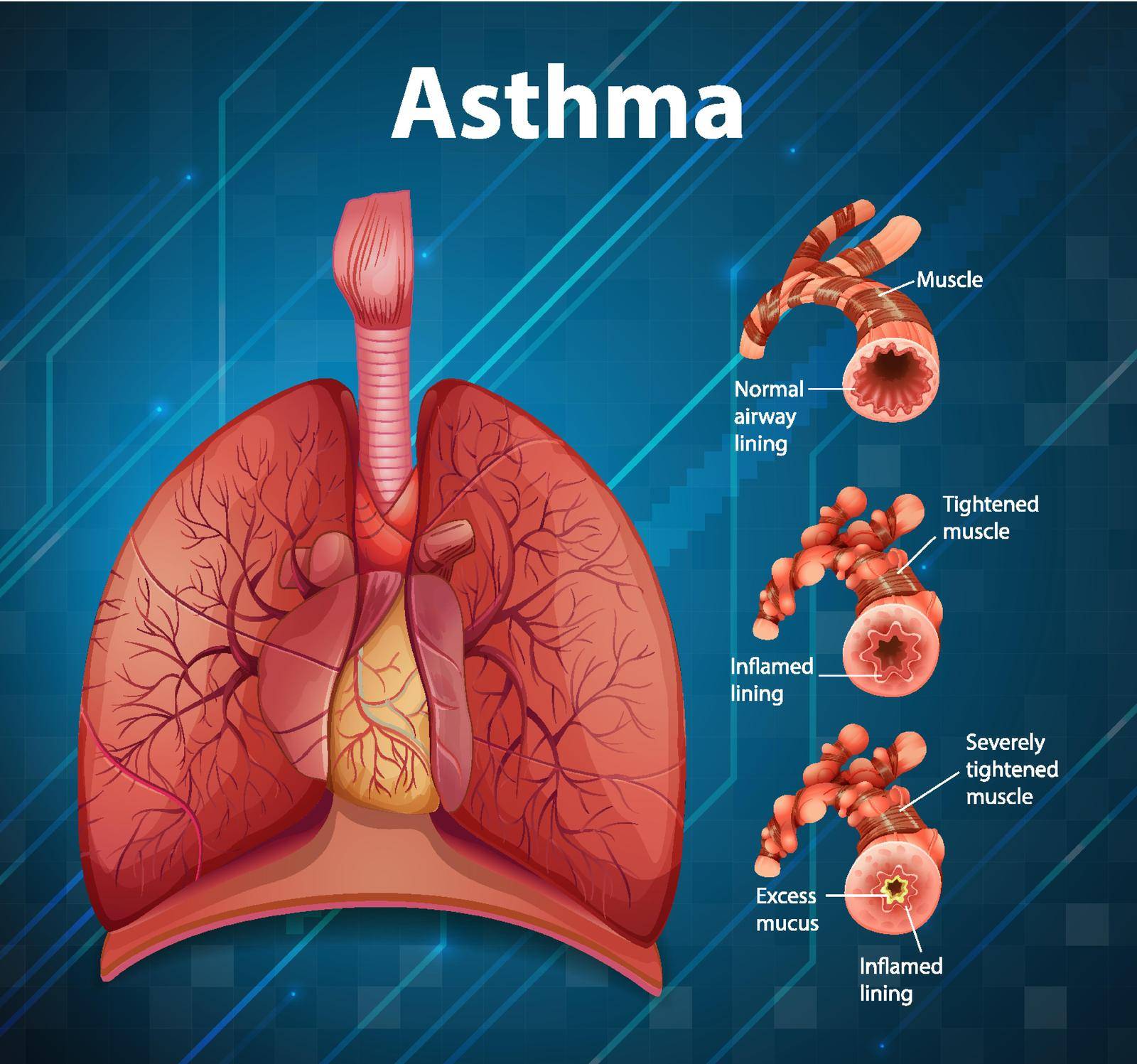 Comparison of healthy lung and Asthmatic lung illustration