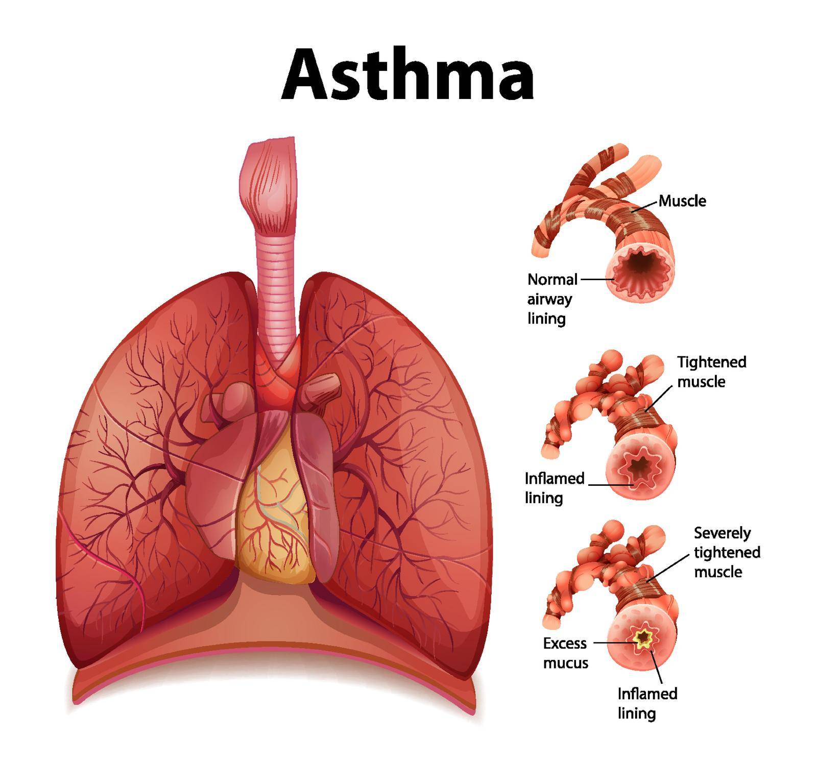 Comparison of healthy lung and Asthmatic lung by iimages