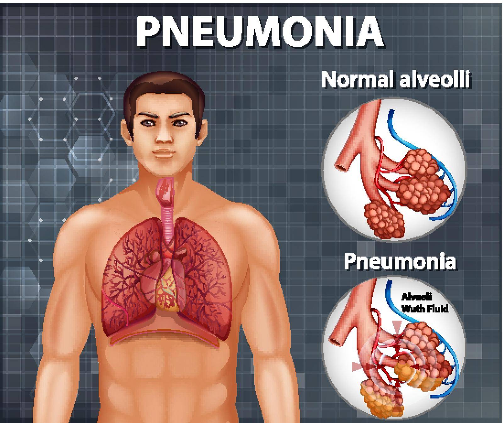 Comparison of healthy alveoli and Pneumonia by iimages