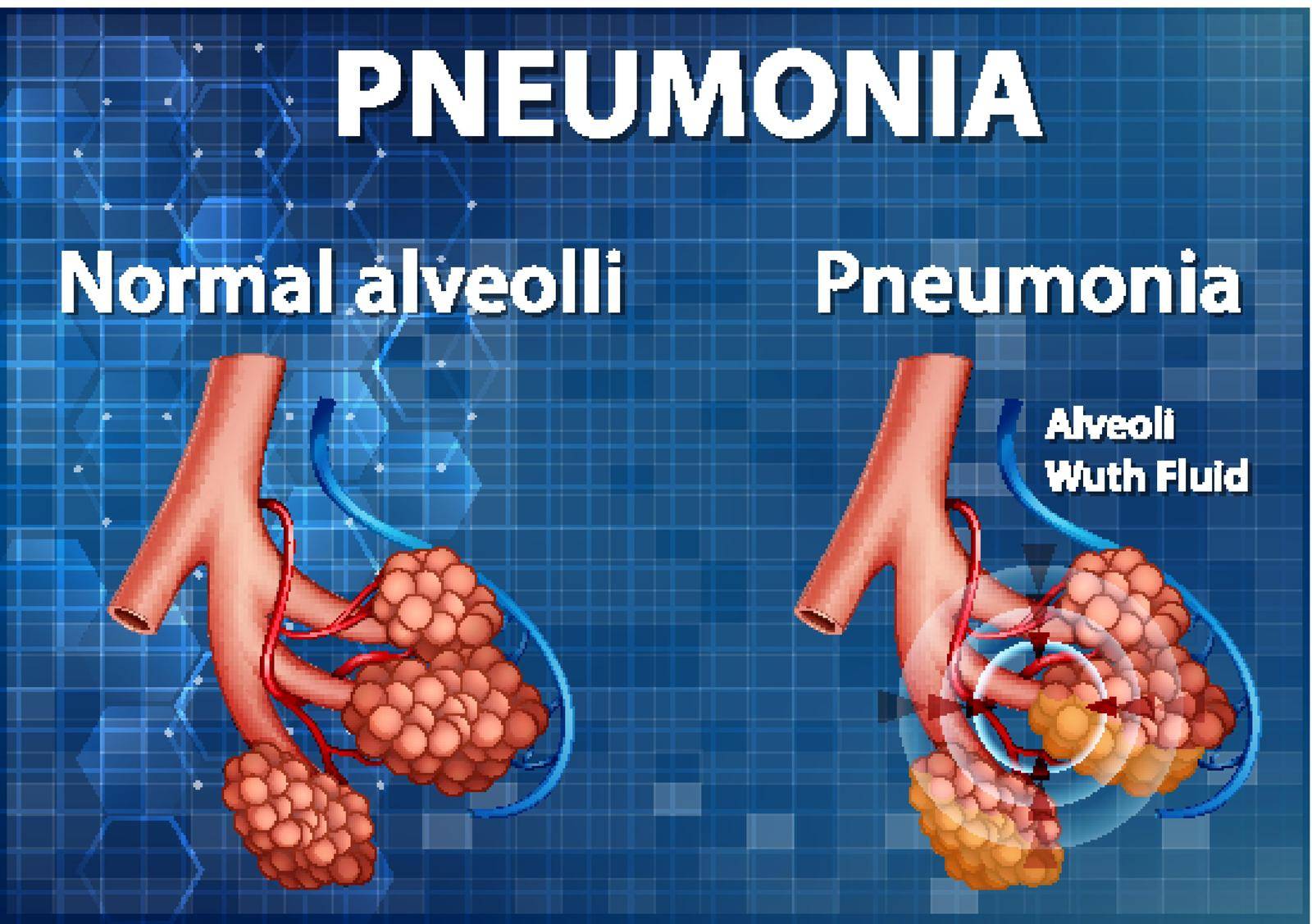 Comparison of healthy alveoli and Pneumonia by iimages