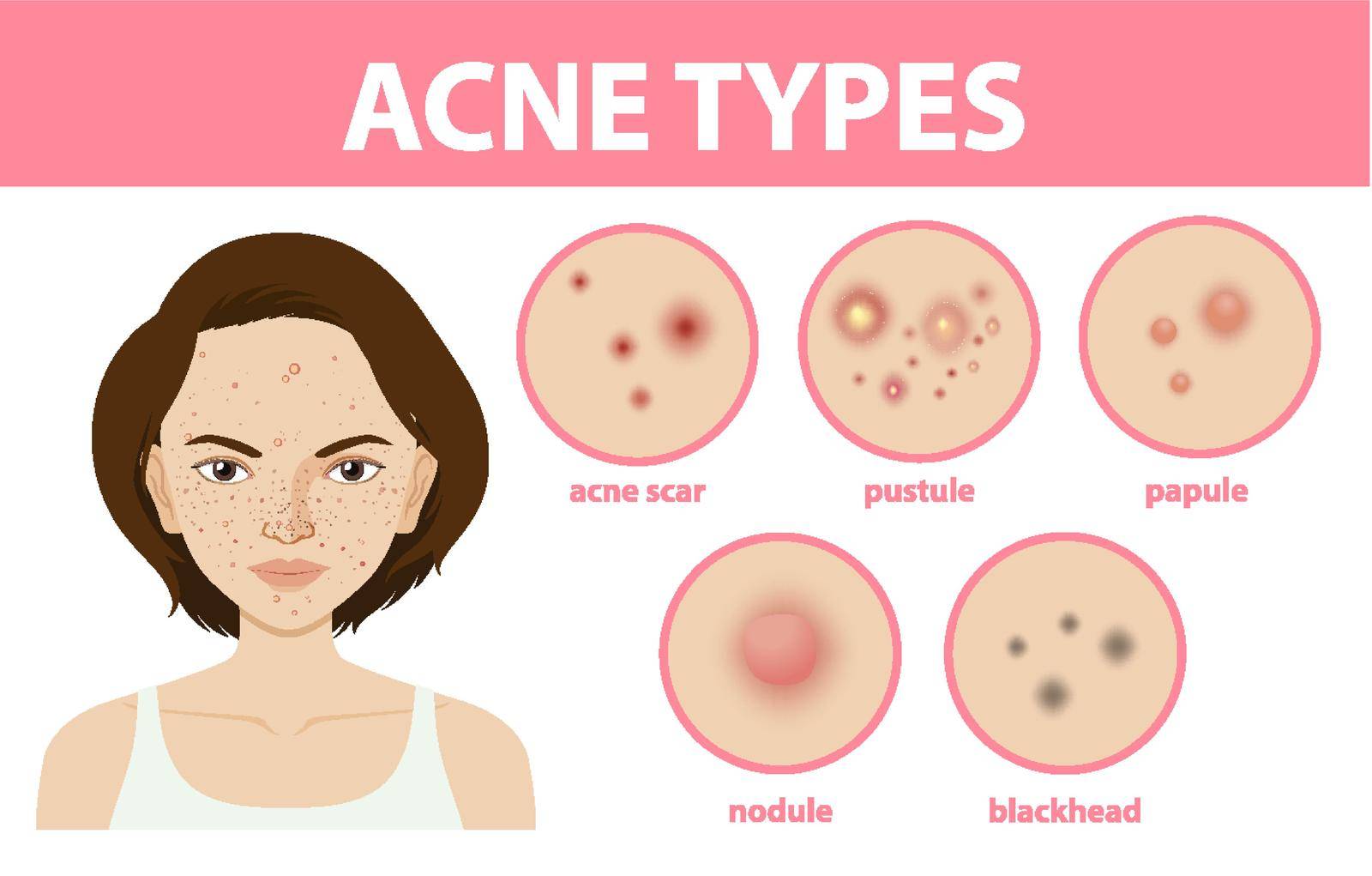 Types of acne on the skin or pimples by iimages