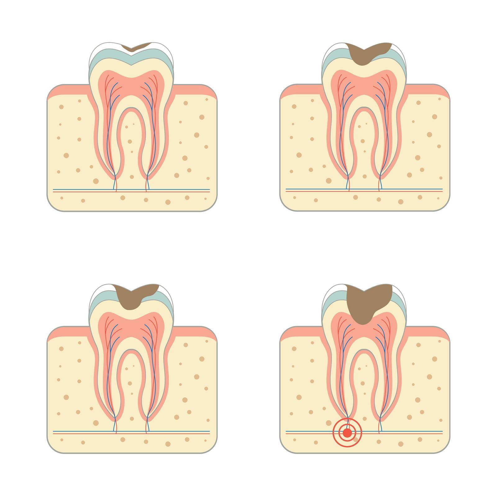 tooth decay disease by eveleen